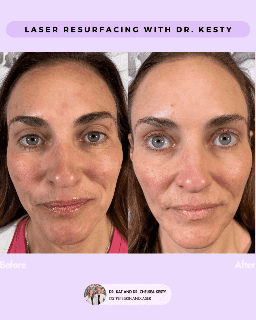 Laser Resurfacing before and after results
