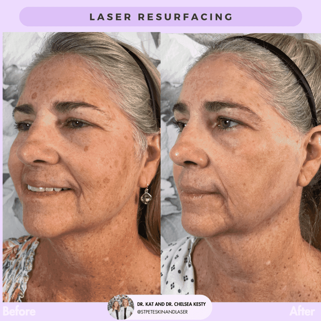 Laser Resurfacing before and after results