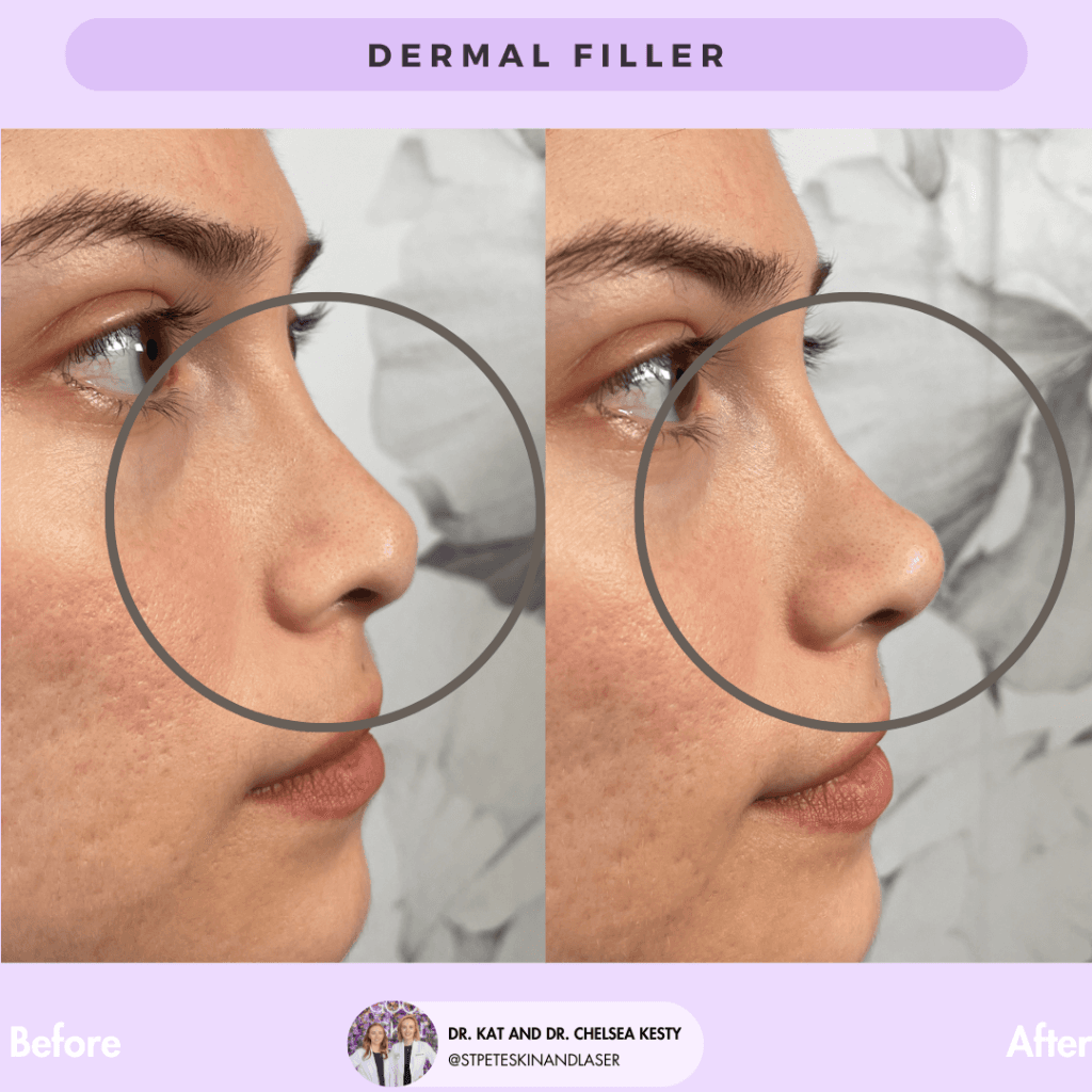Dermal Fillers before and after results