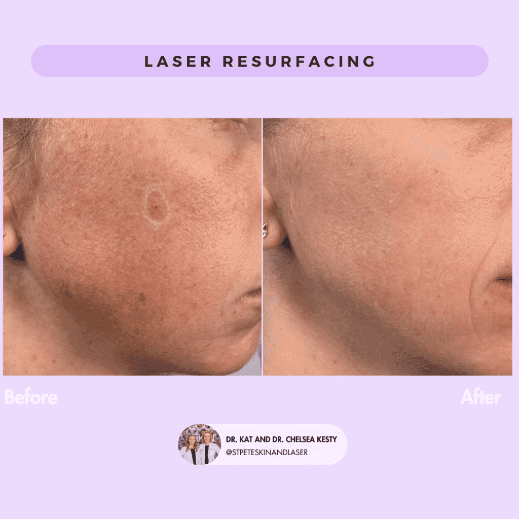 Laser Resurfacing before and after results