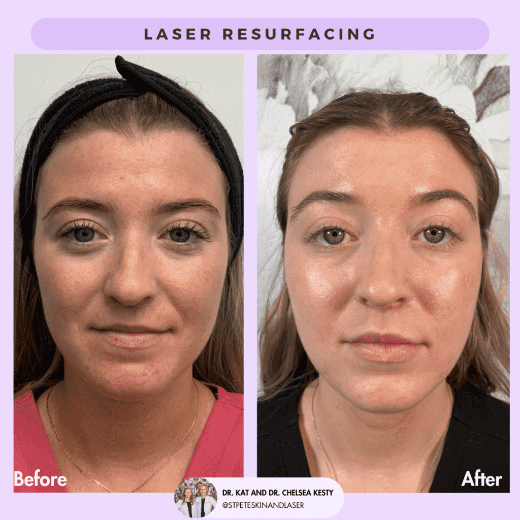 Laser Resurfacing before and after results