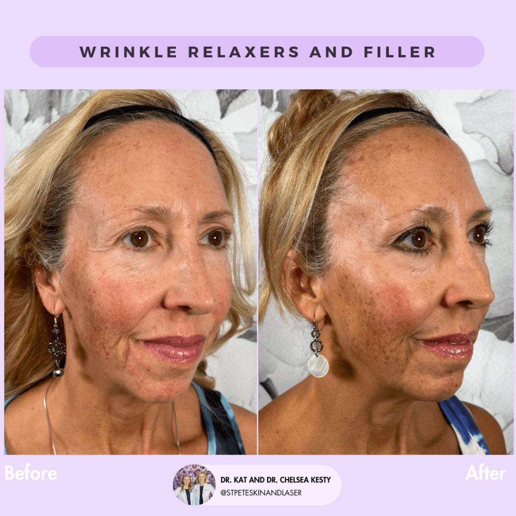 Wrinkle Relaxers before and after results