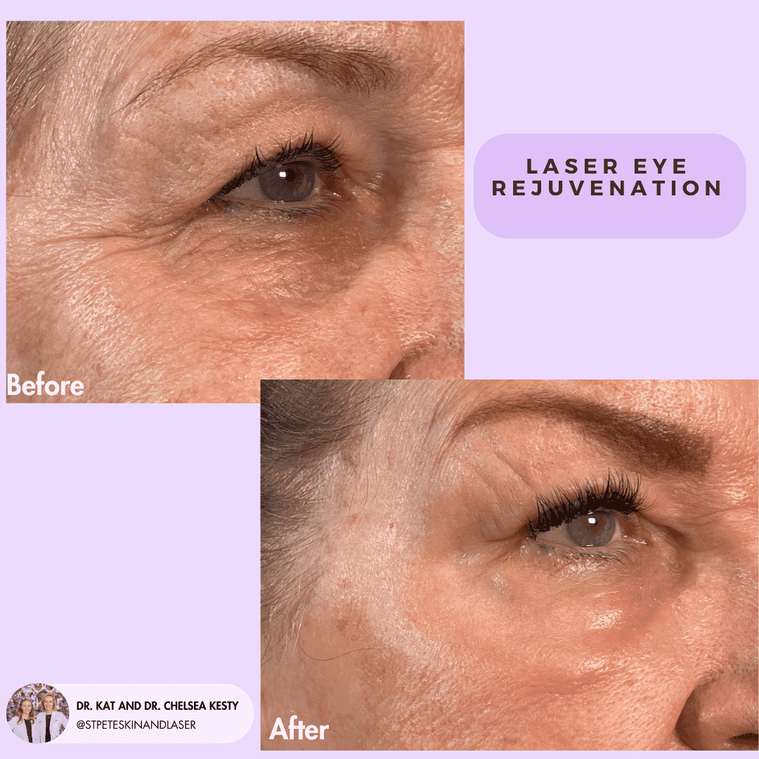Eye Rejuvenation before and after results