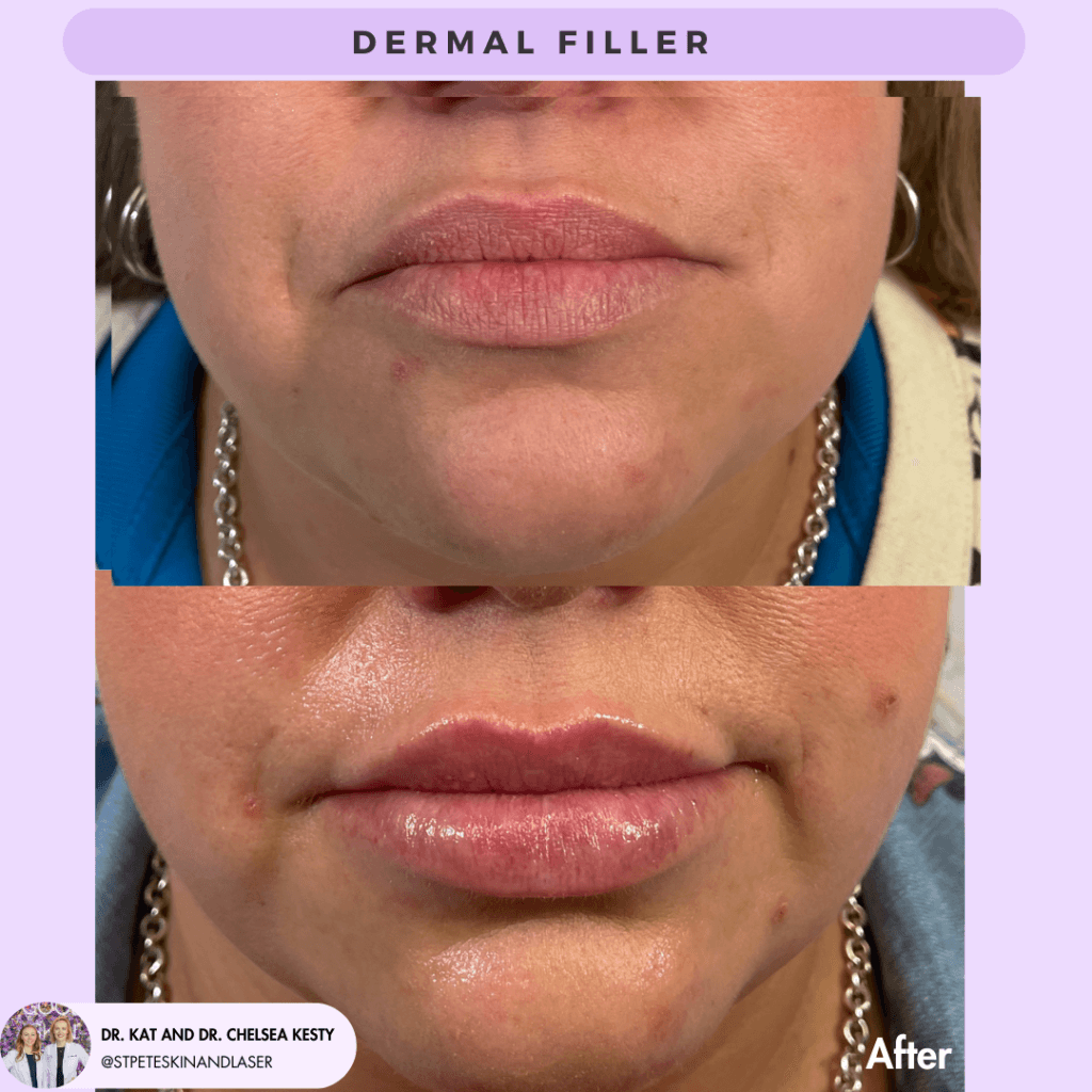 Dermal Fillers before and after results