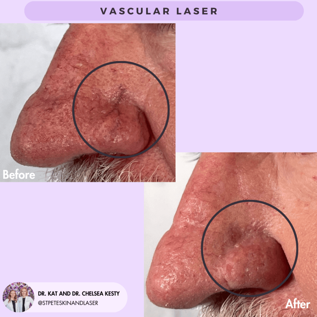 Vascular Laser before and after results