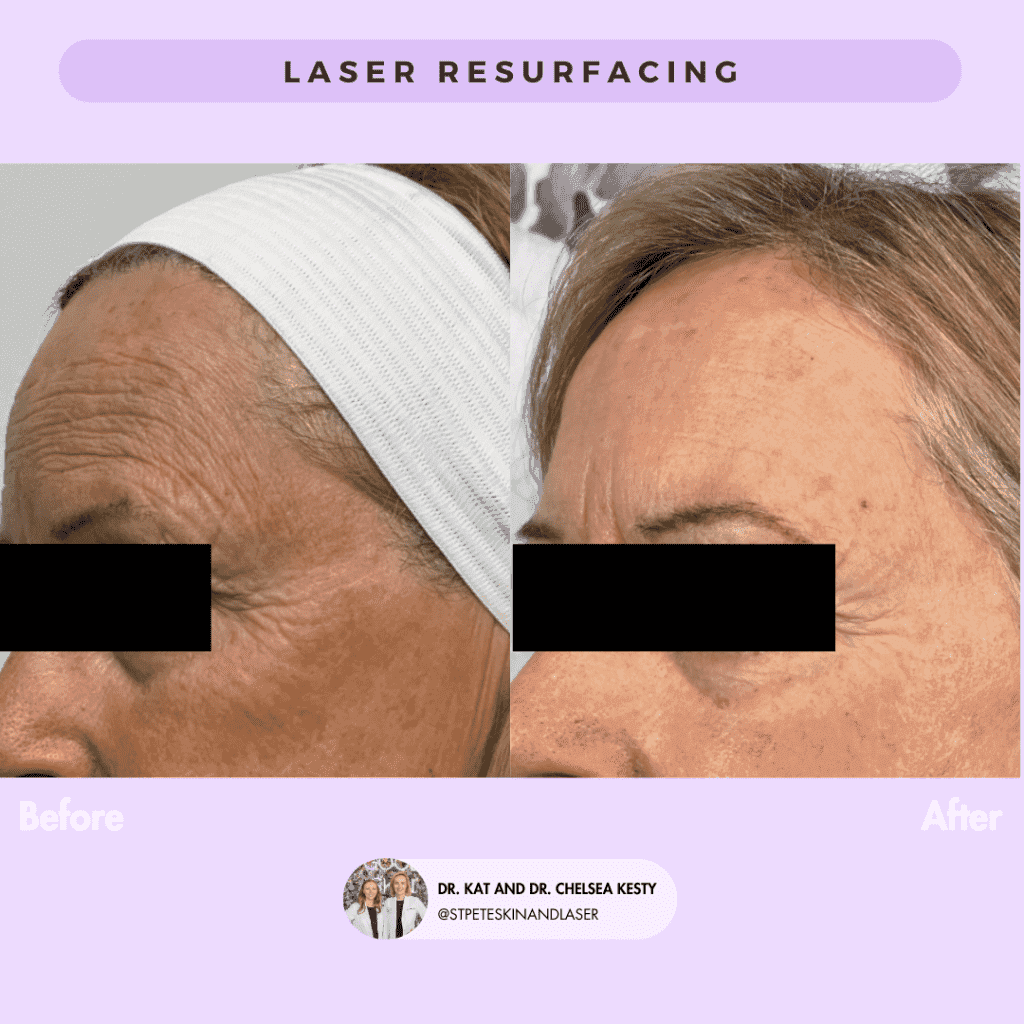 Laser Resurfacing before and after results