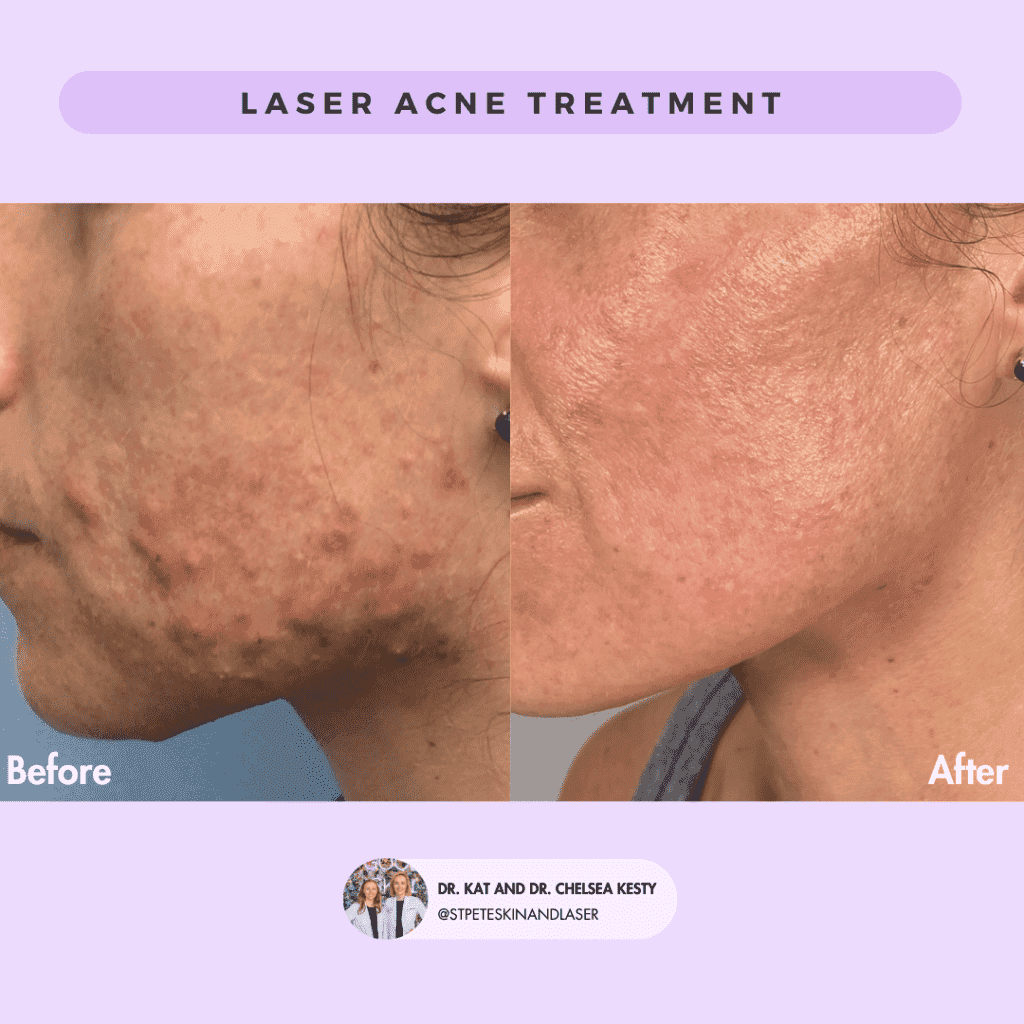 Laser Resurfacing before and after results
