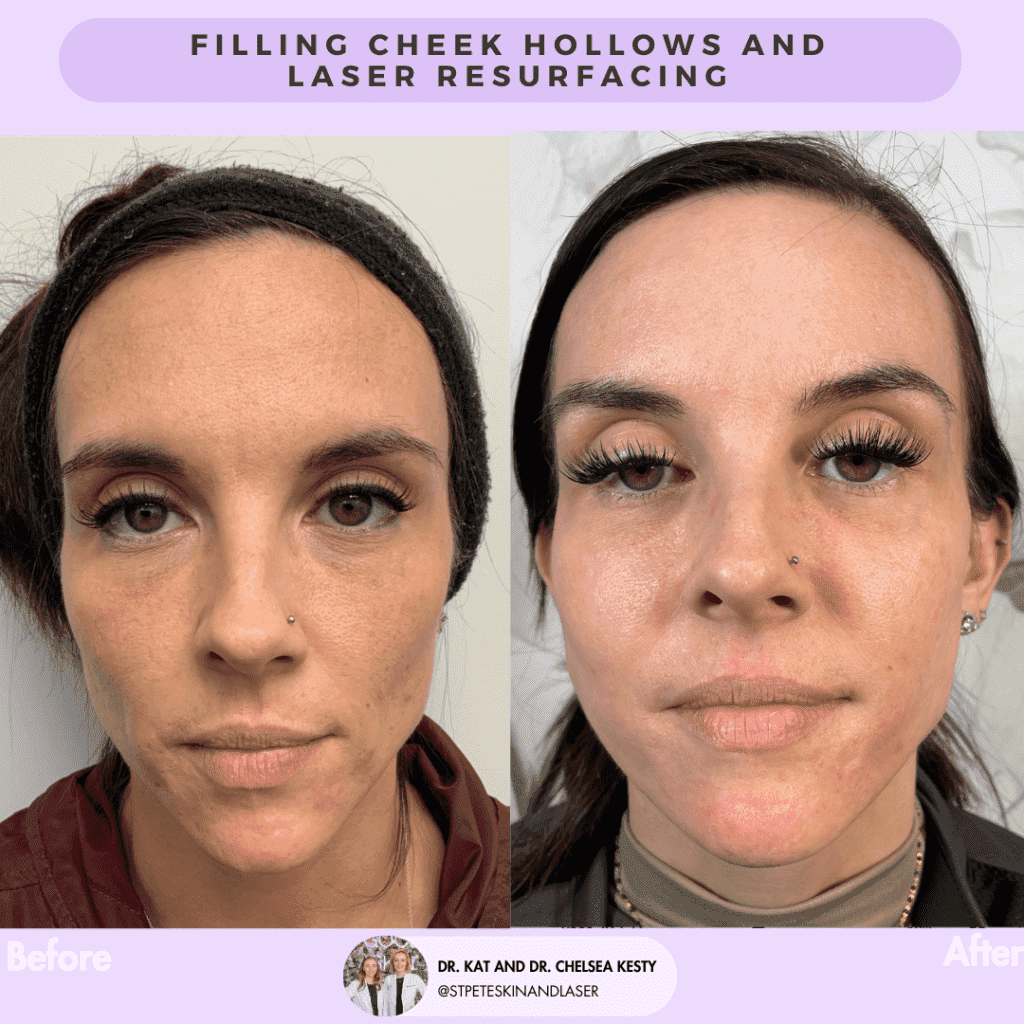 Laser Resurfacing before and after results