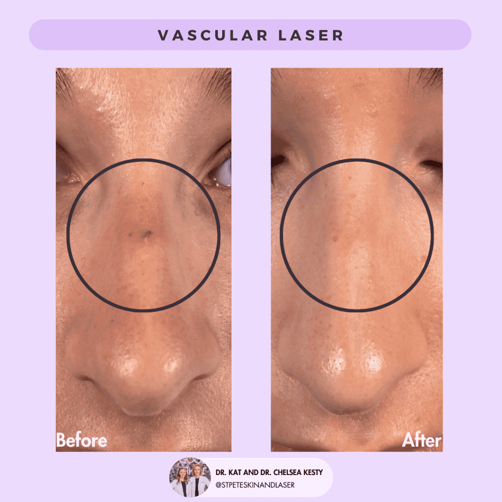 Vascular Laser before and after results