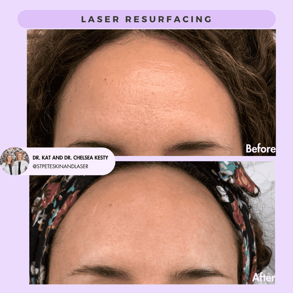 Laser Resurfacing before and after results