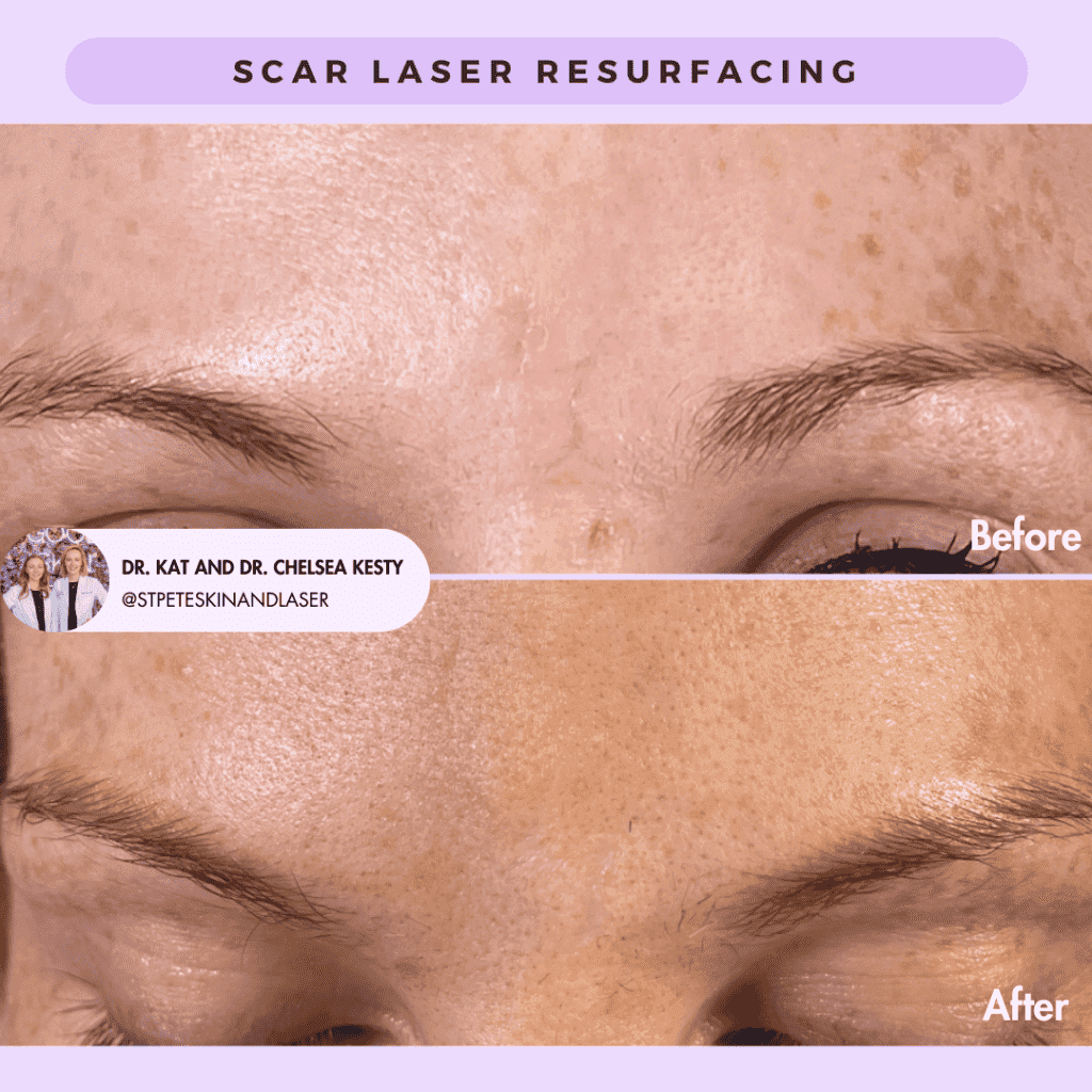 Laser Resurfacing before and after results