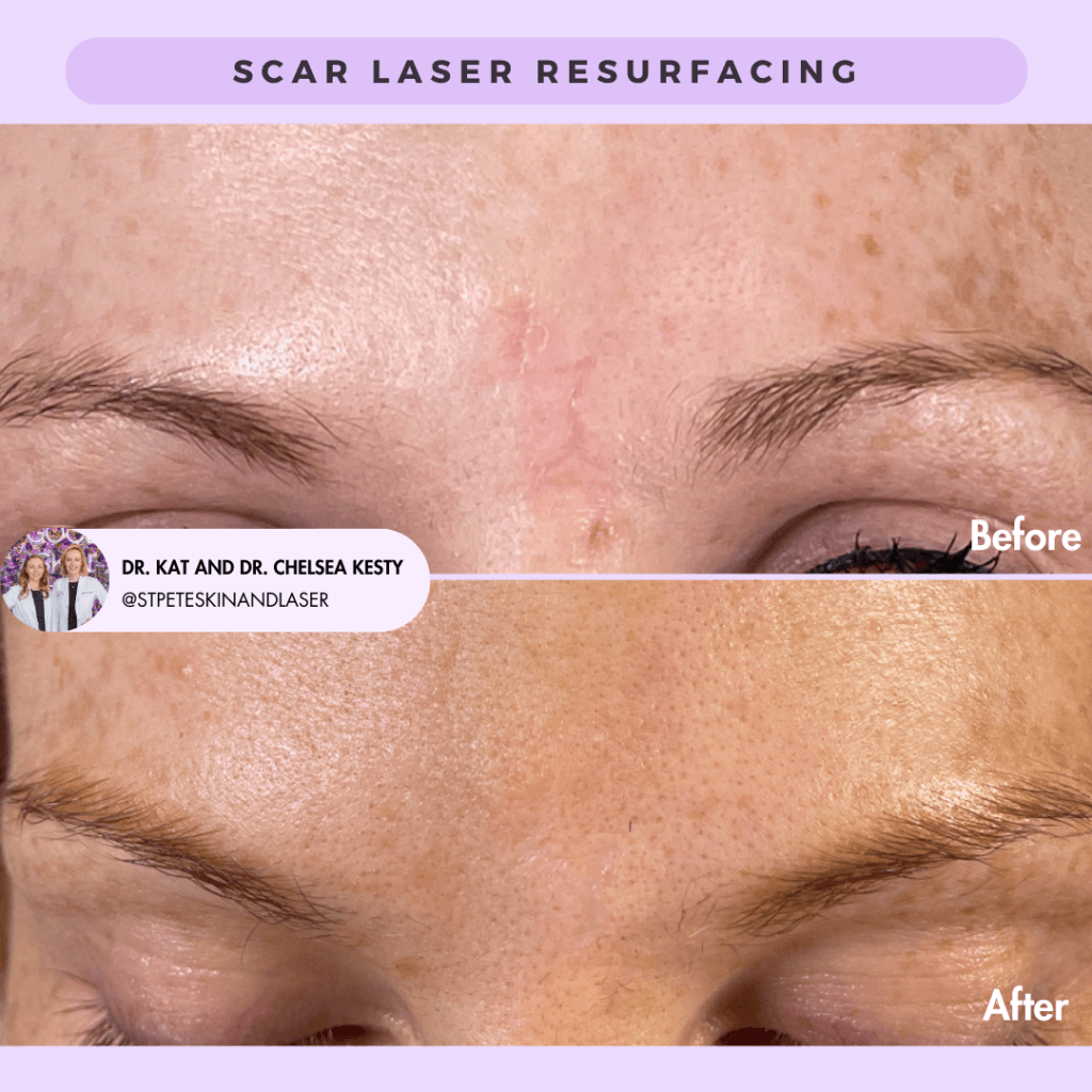 Laser Treatment of Scars before and after results