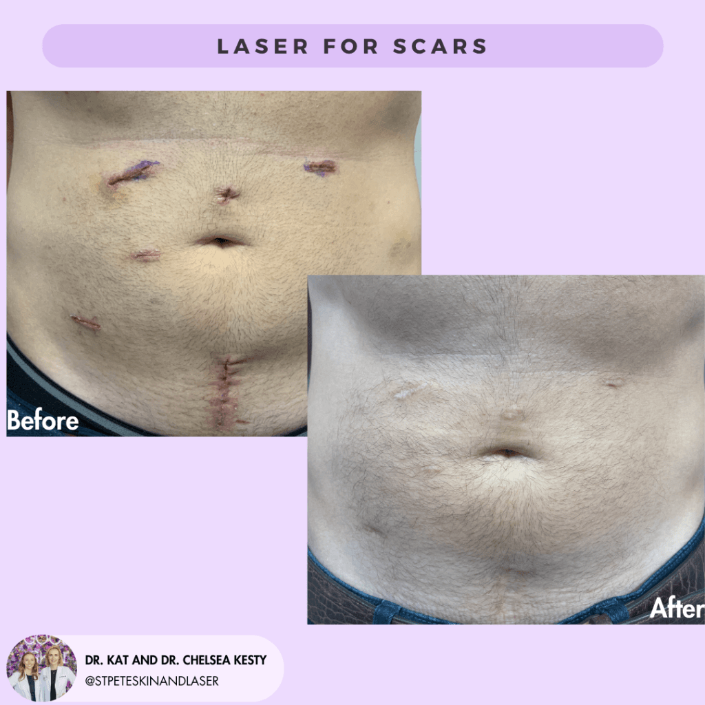 Laser Treatment of Scars before and after results