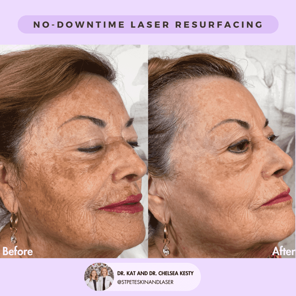 Laser Resurfacing before and after results