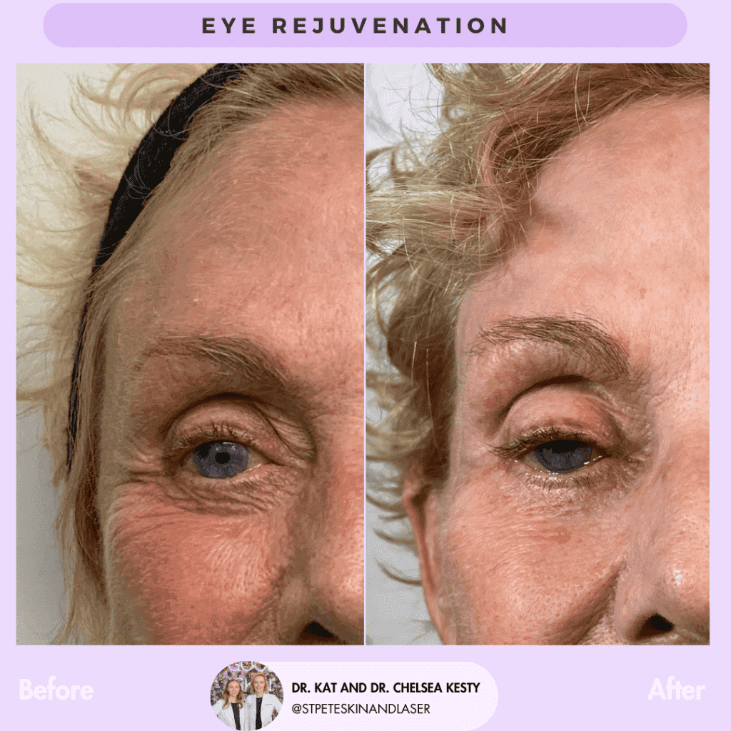 Eye Rejuvenation before and after results