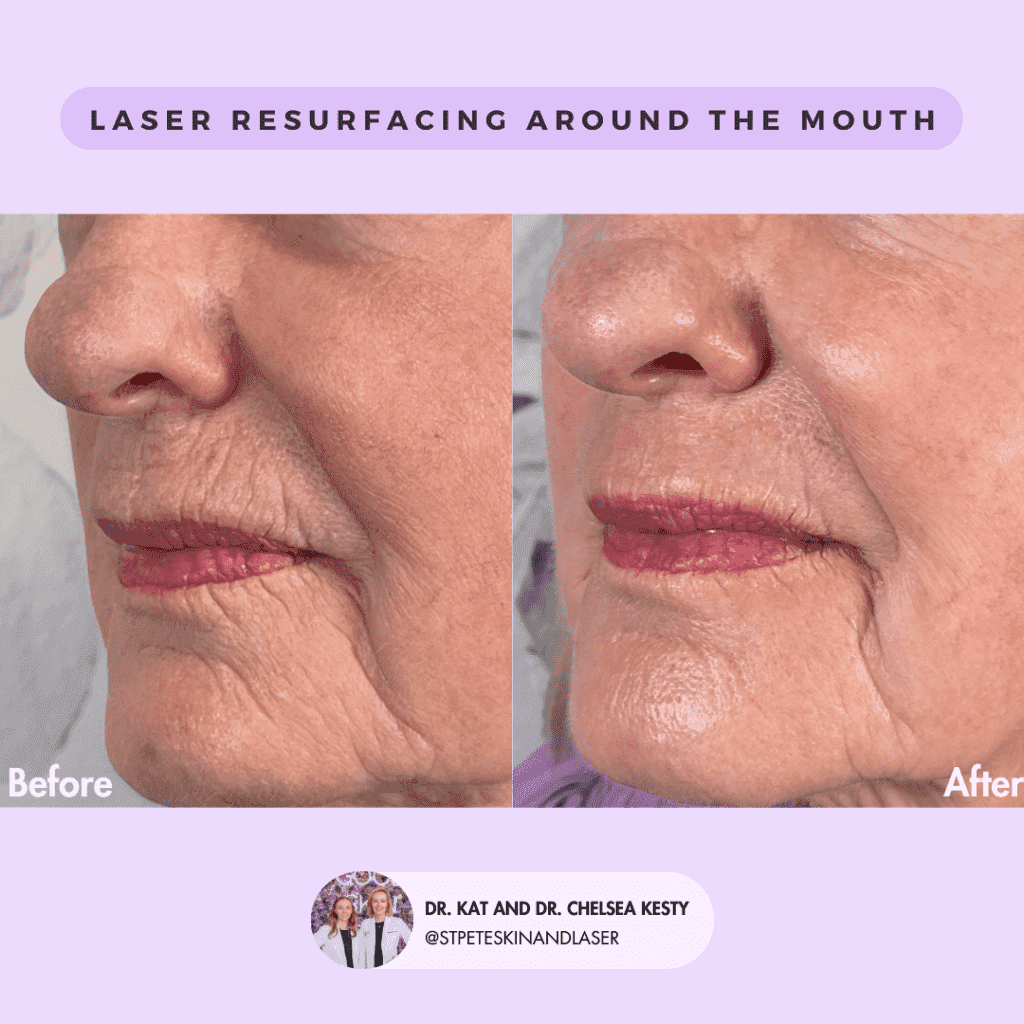 Laser Resurfacing before and after results