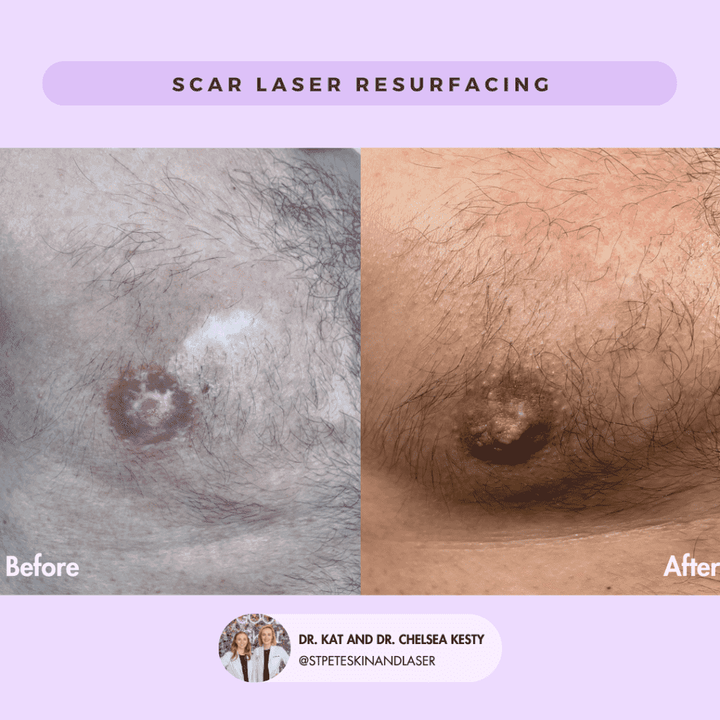 Laser Treatment of Scars before and after results