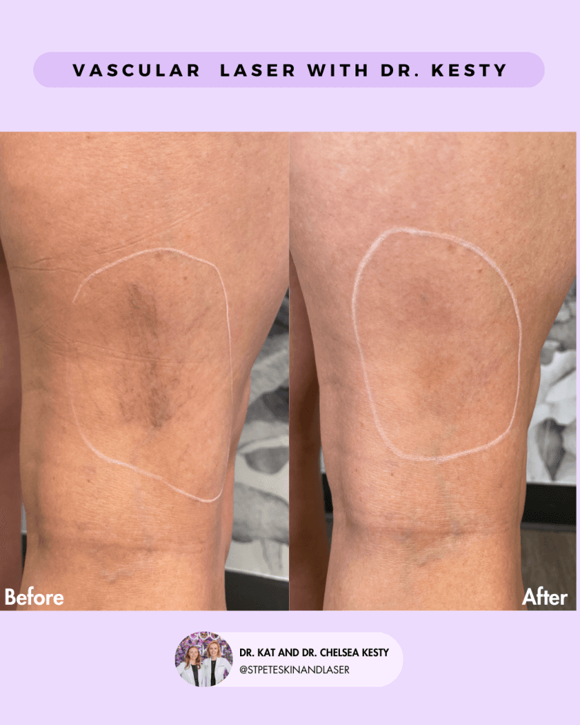Vascular Laser before and after results