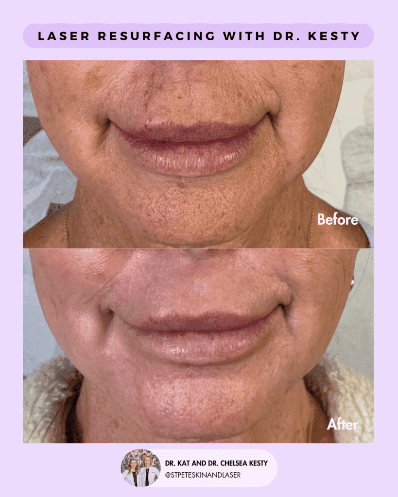 Laser Resurfacing before and after results