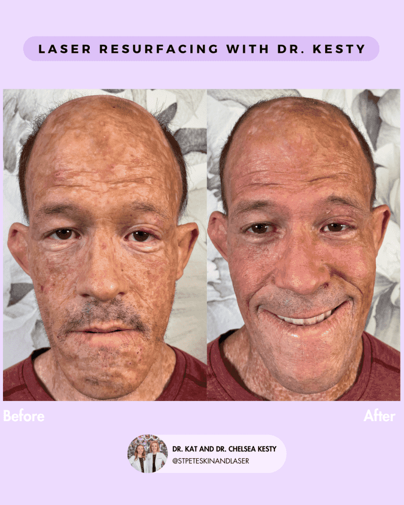 Laser Resurfacing before and after results