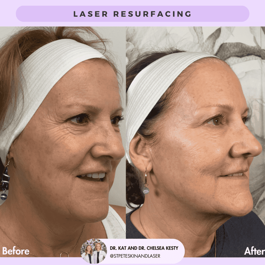 Laser Resurfacing before and after results