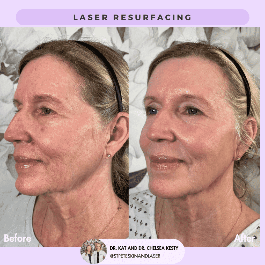Laser Resurfacing before and after results