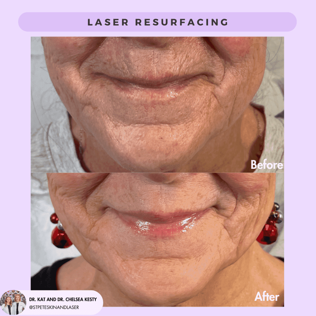 Laser Resurfacing before and after results