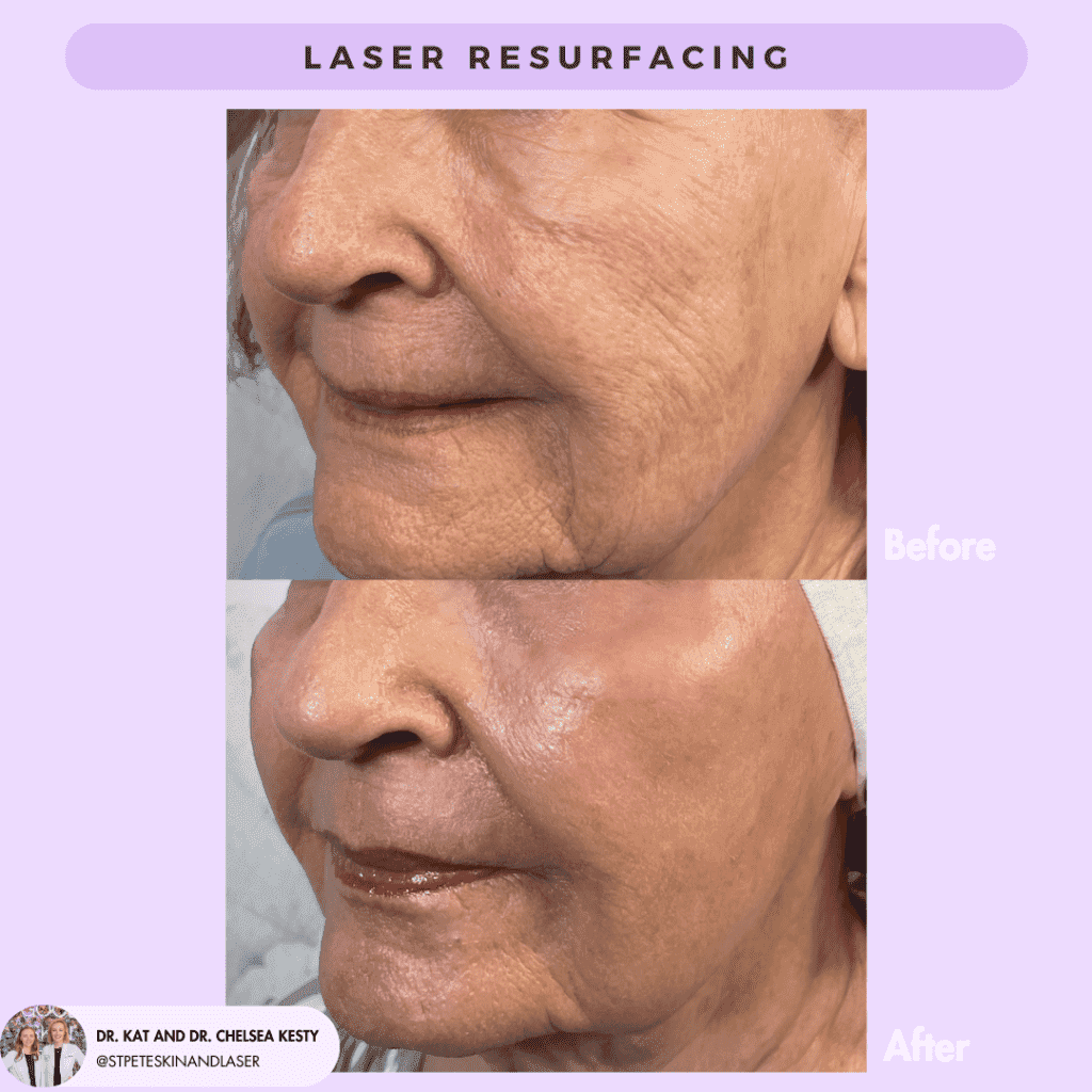 Laser Resurfacing before and after results