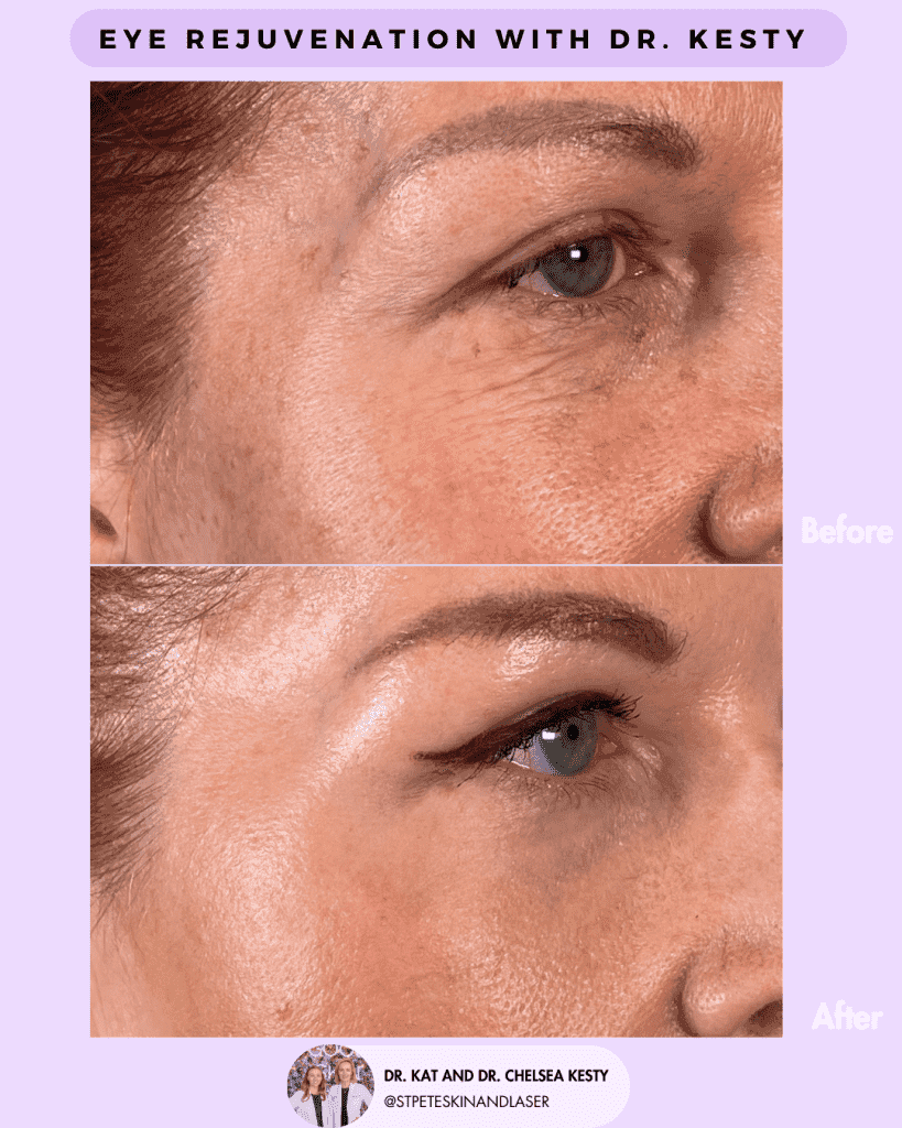 Eye Rejuvenation before and after results