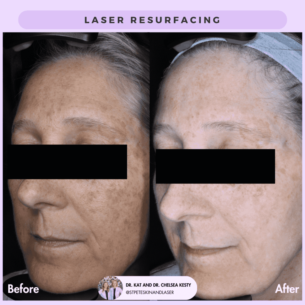Laser Resurfacing before and after results
