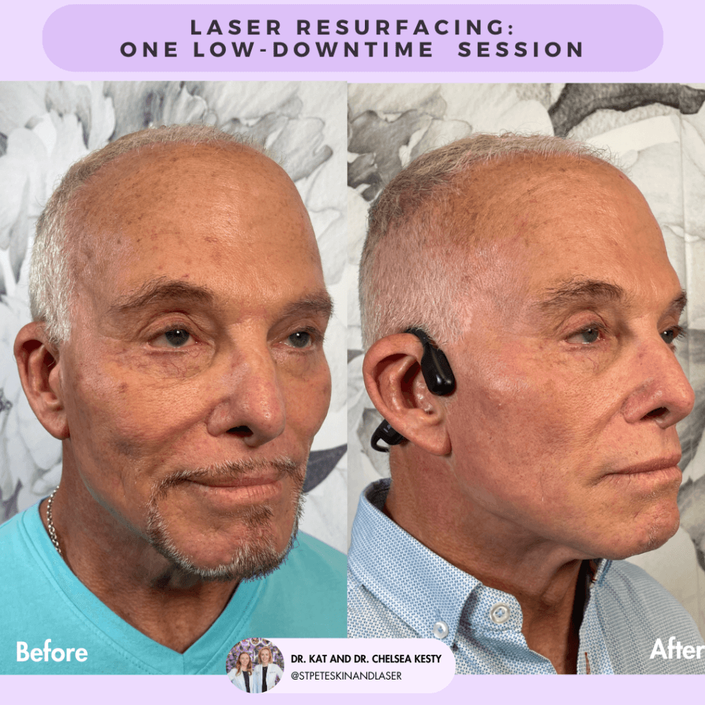 Laser Resurfacing before and after results