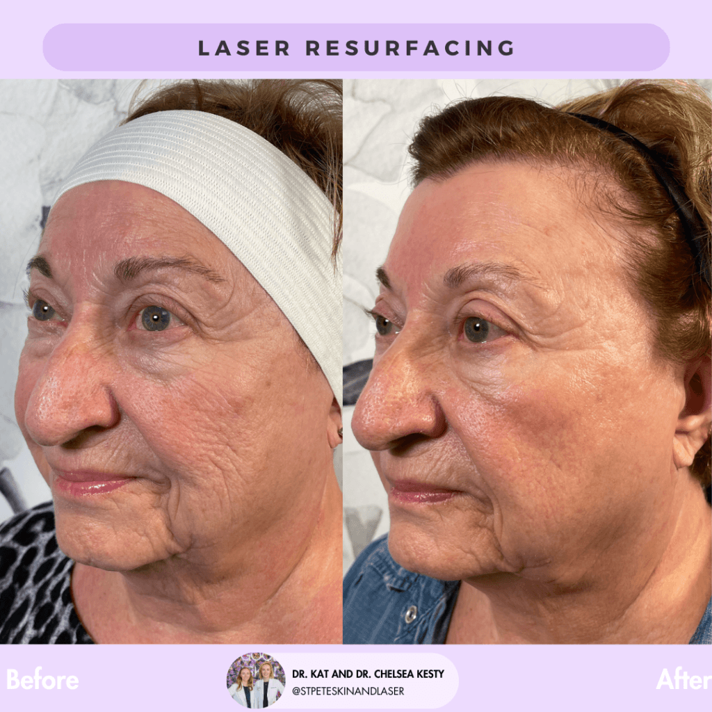 Laser Resurfacing before and after results
