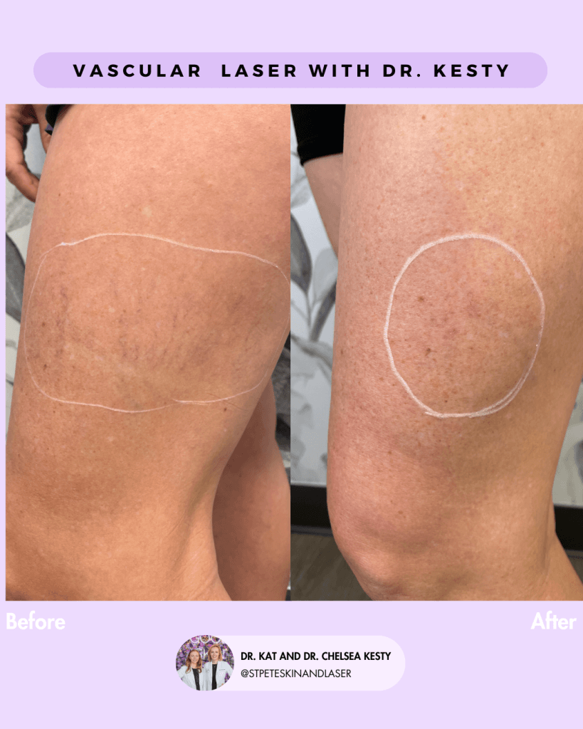 Vascular Laser before and after results