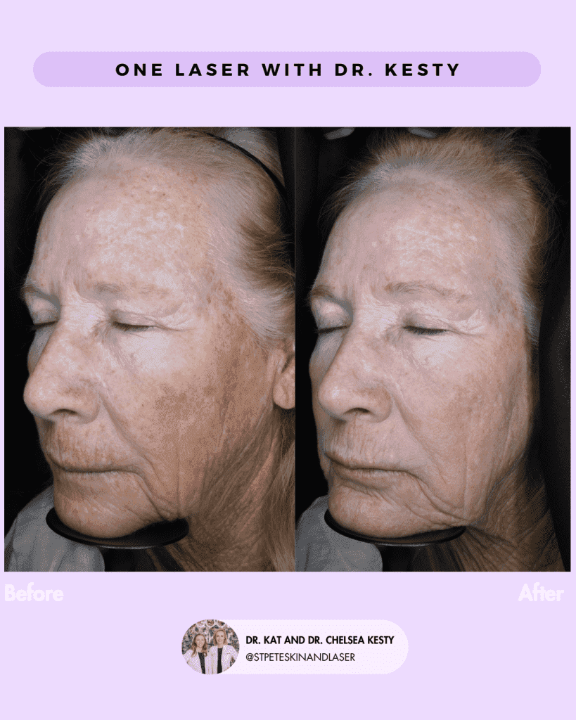Laser Resurfacing before and after results