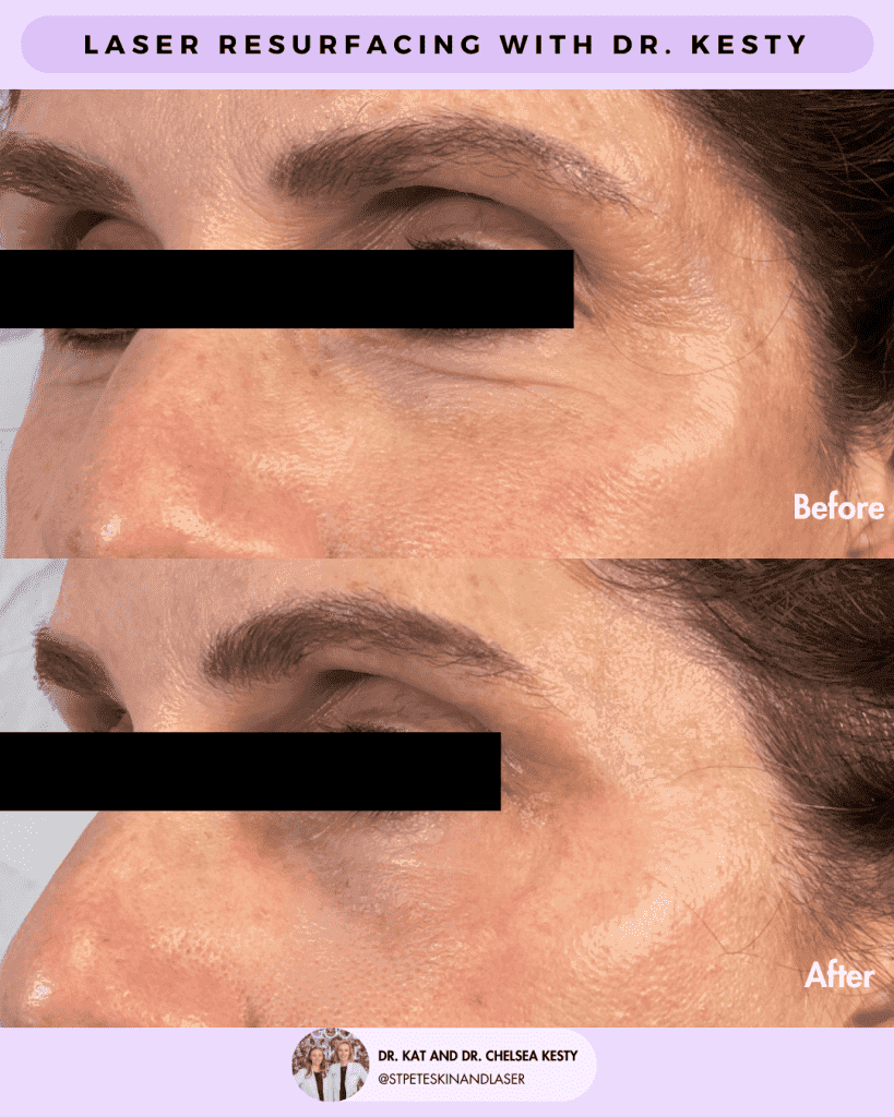Laser Resurfacing before and after results