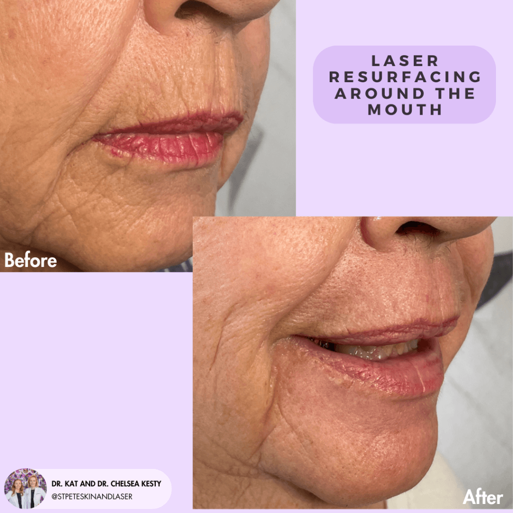 Laser Resurfacing before and after results