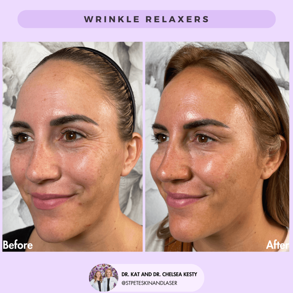 Wrinkle Relaxers before and after results
