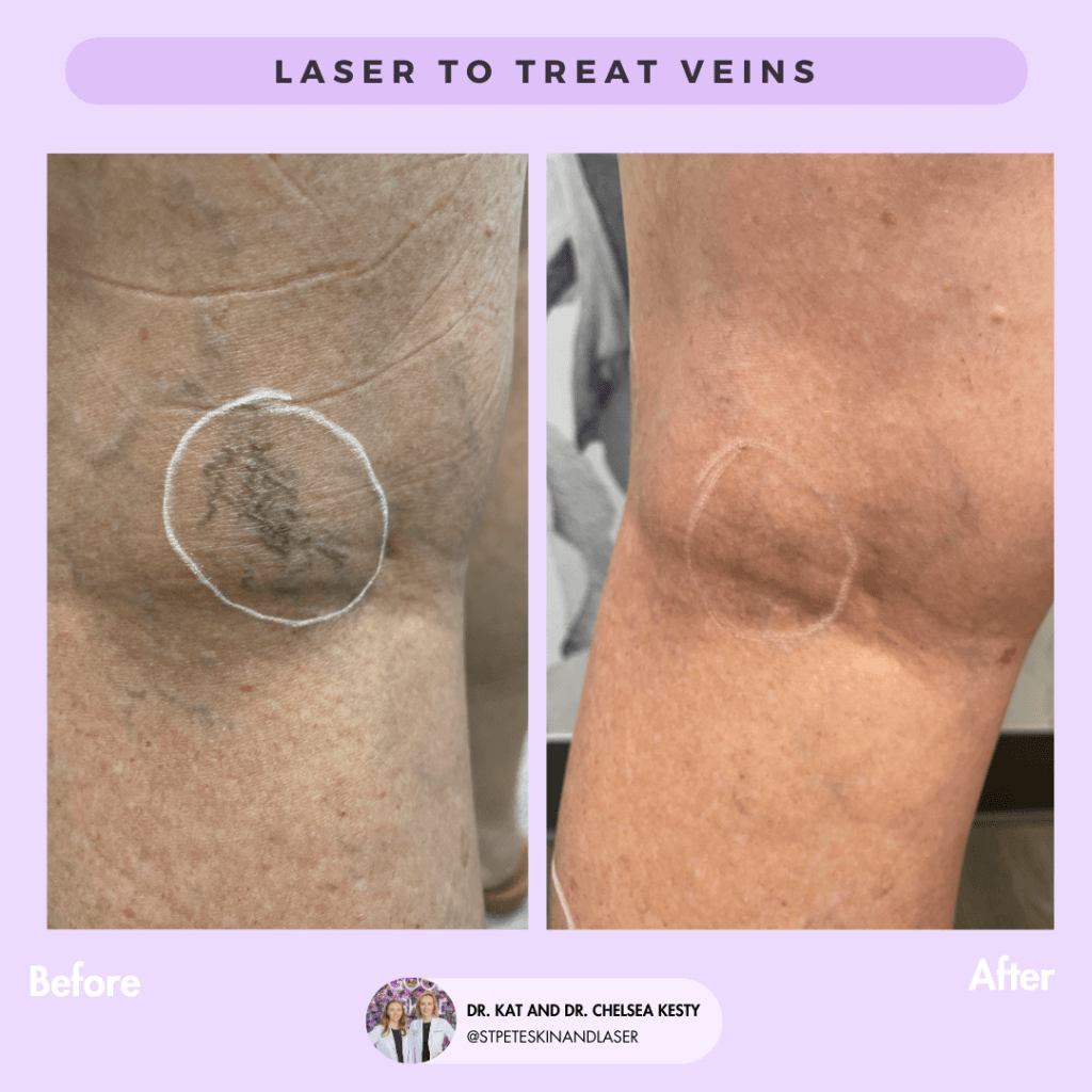 Vascular Laser before and after results