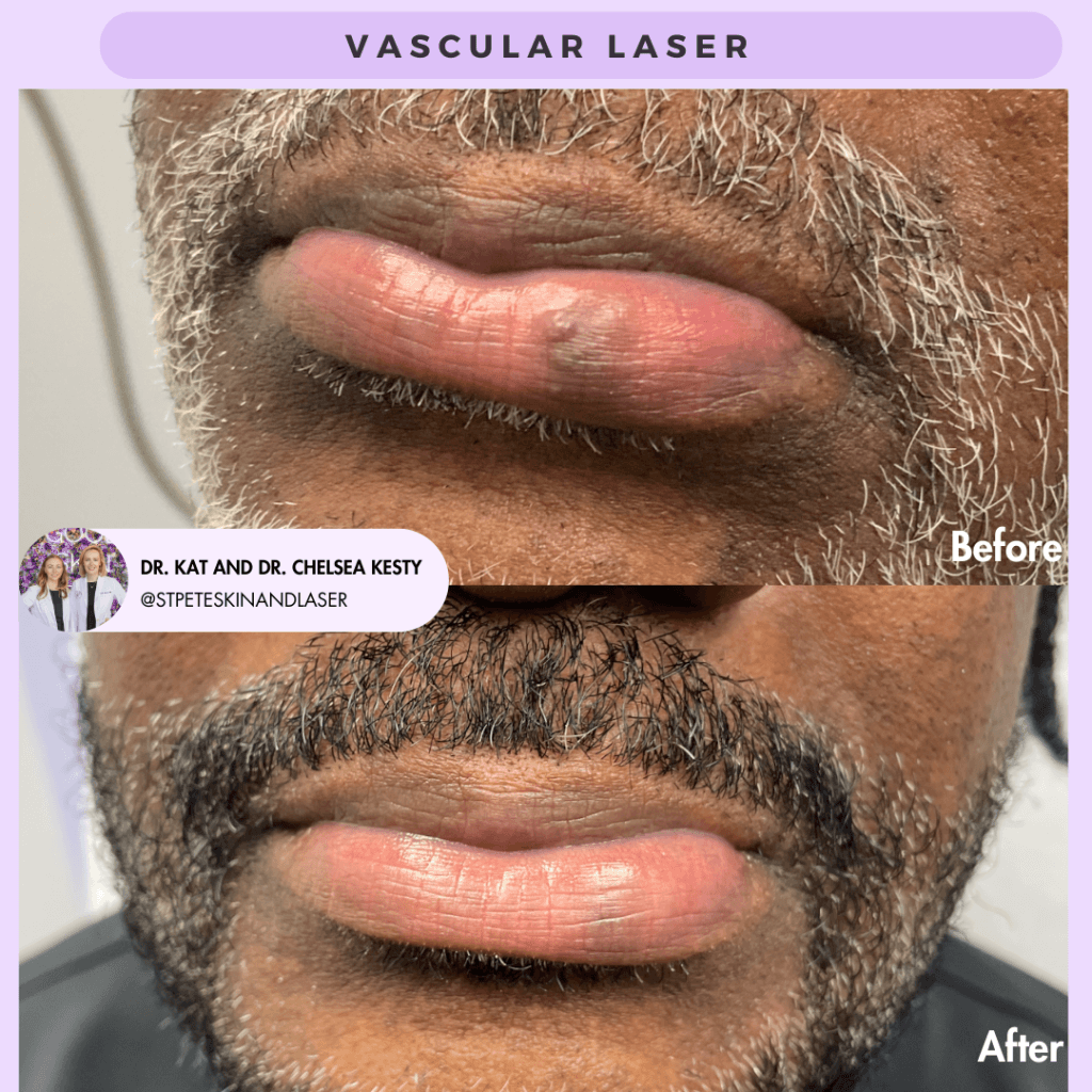 Vascular Laser before and after results