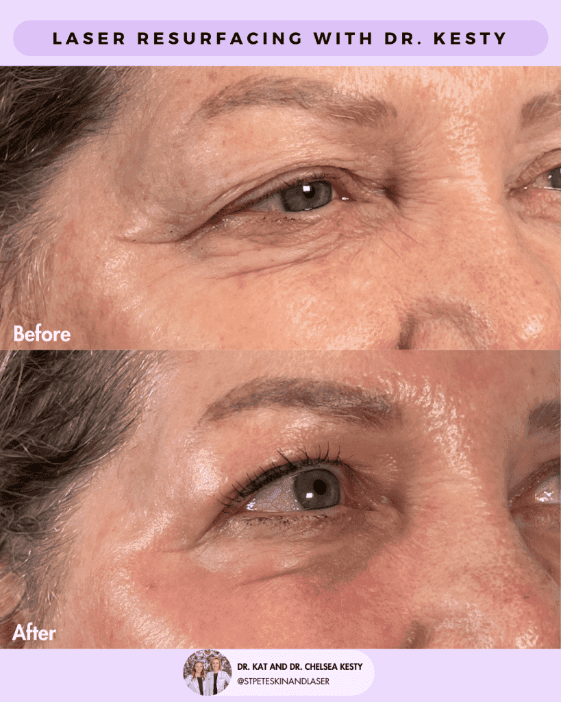 Laser Resurfacing before and after results