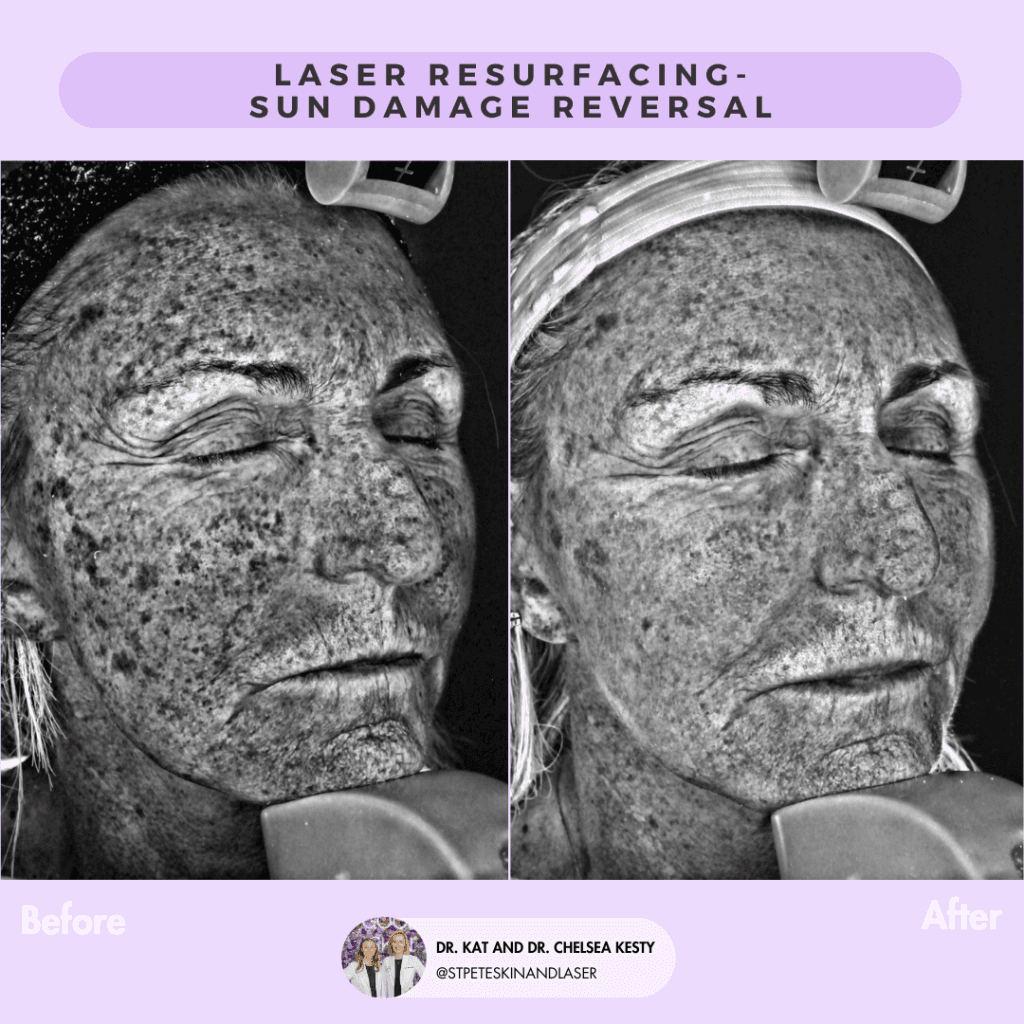 Laser Resurfacing before and after results