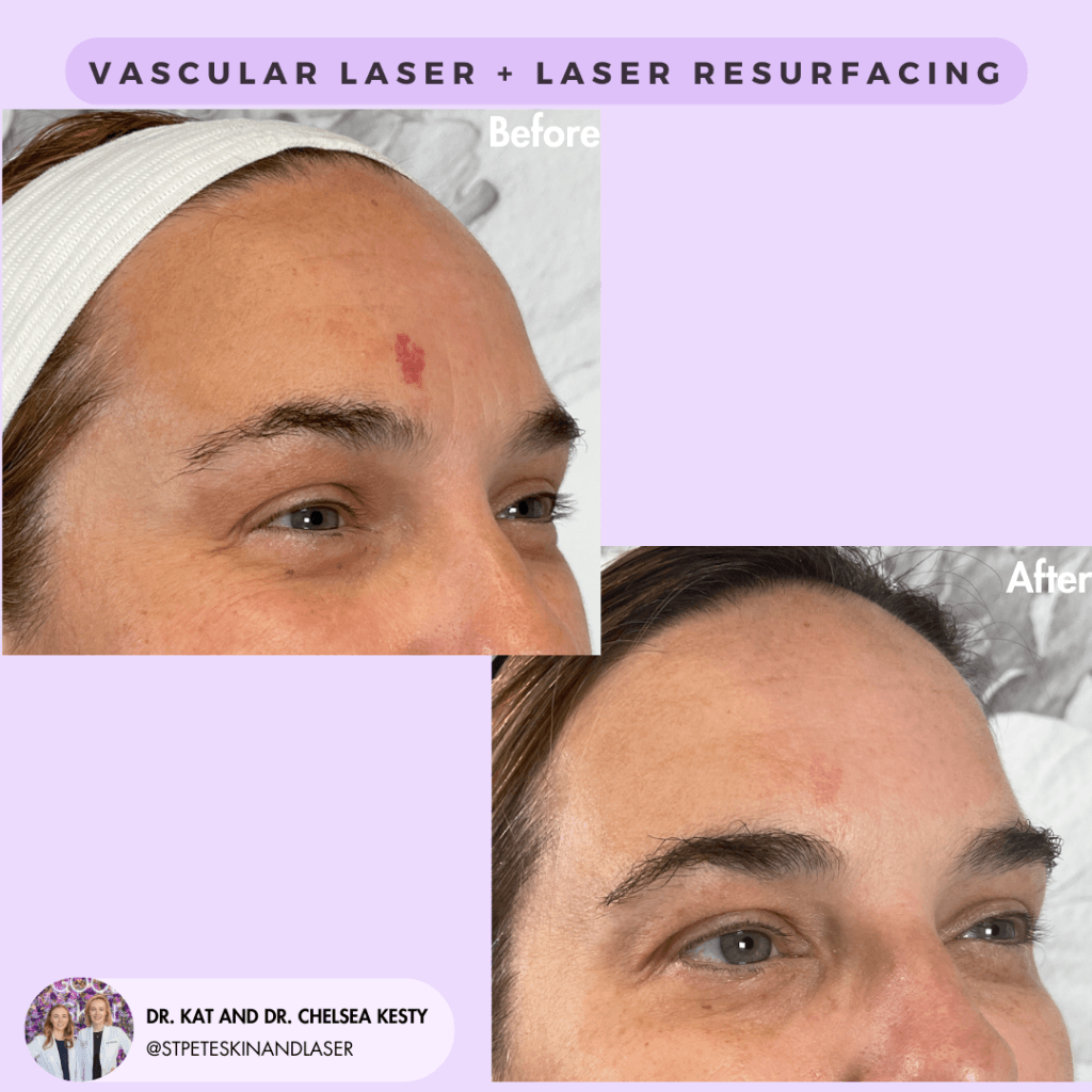 Vascular Laser before and after results