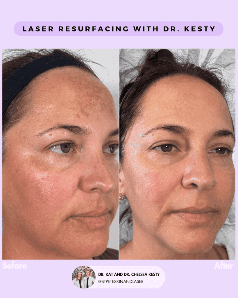Laser Resurfacing before and after results