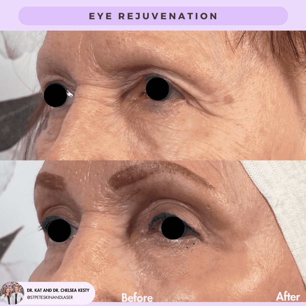 Eye Rejuvenation before and after results