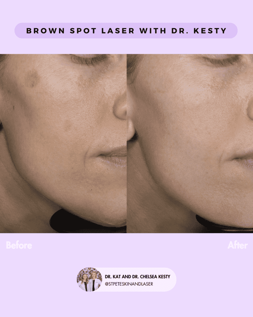 Laser Resurfacing before and after results