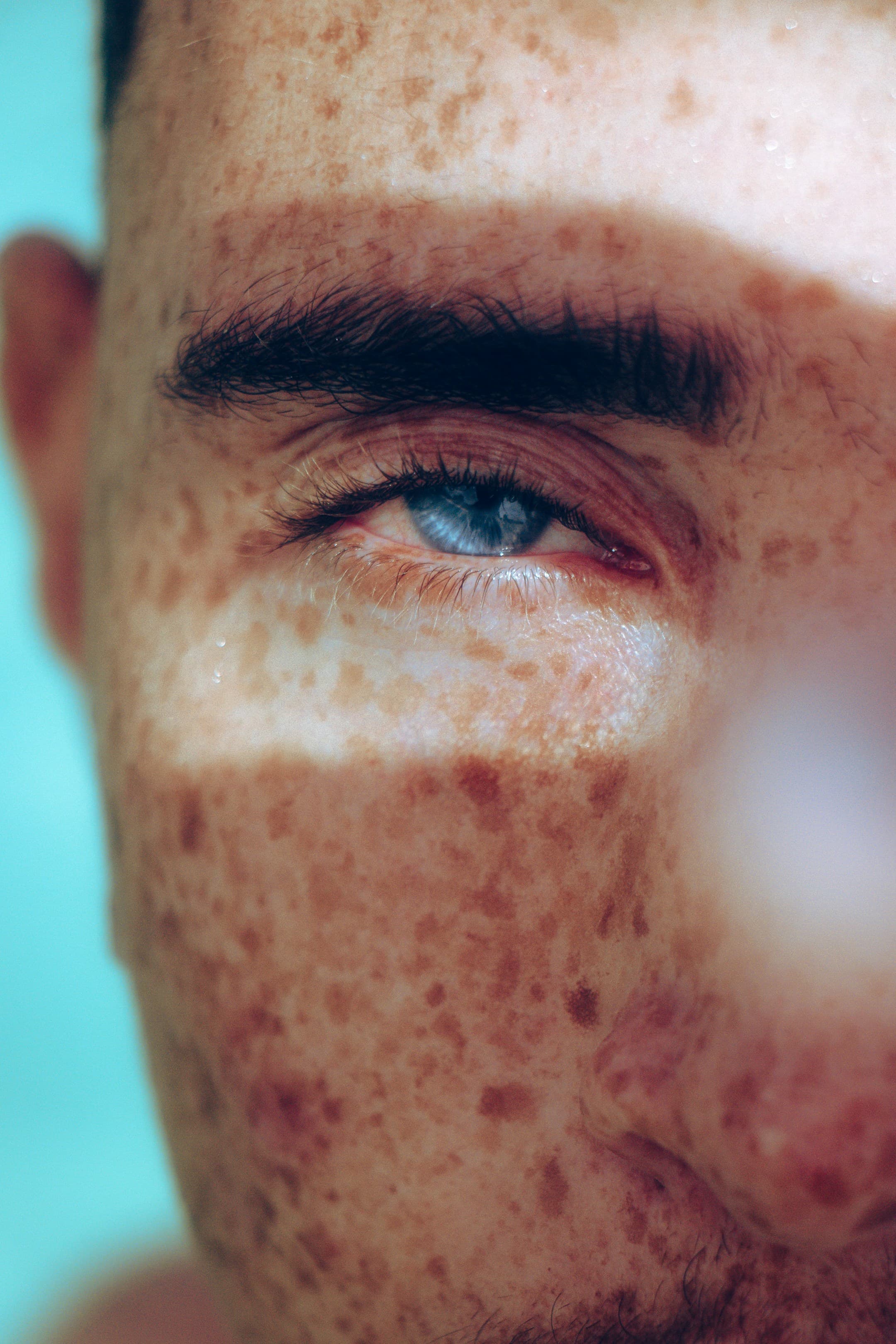 Using lasers to treat actinic keratoses